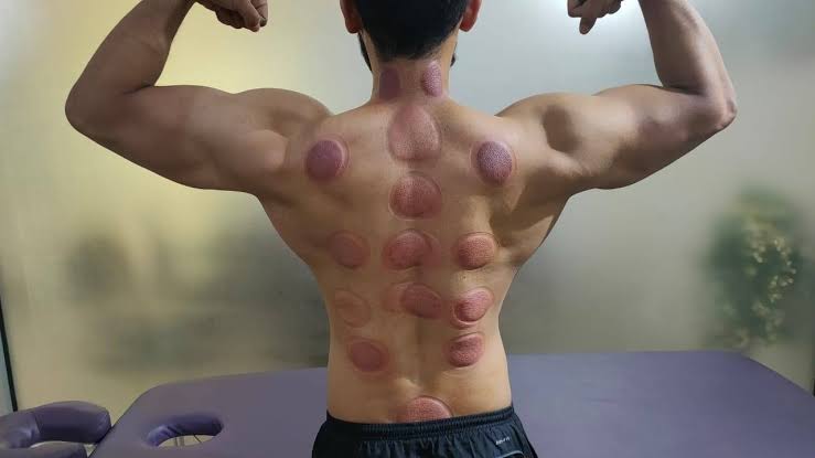 body cupping massage in hyderabad