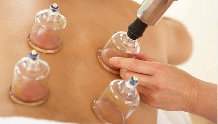 top cupping near by me